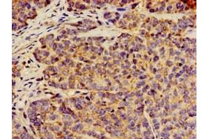 Immunohistochemistry of paraffin-embedded human ovarian cancer using ABIN7144300 at dilution of 1:100 (ANO1 Antikörper  (AA 1-151))