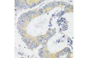 Immunohistochemistry of paraffin-embedded human colon carcinoma using Snail antibody (ABIN6132675, ABIN6148177, ABIN6148180 and ABIN6221190) at dilution of 1:100 (40x lens). (SNAIL Antikörper  (C-Term))