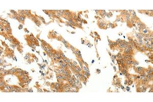 Immunohistochemistry of paraffin-embedded Human gastric cancer using RARRES1 Polyclonal Antibody at dilution of 1:60 (RARRES1 Antikörper)