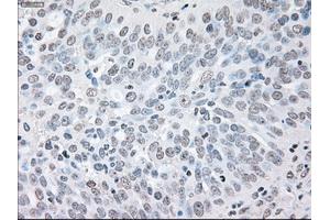 Immunohistochemical staining of paraffin-embedded Adenocarcinoma of colon tissue using anti-BRAFmouse monoclonal antibody. (BRAF Antikörper)