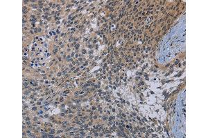 Immunohistochemistry of Human cervical cancer using CDC16 Polyclonal Antibody at dilution of 1:50 (CDC16 Antikörper)