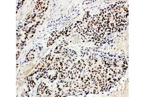 IHC-P: MCM3 antibody testing of human lung cancer tissue (MCM3 Antikörper  (N-Term))