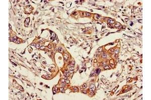 Immunohistochemistry of paraffin-embedded human pancreatic cancer using ABIN7169690 at dilution of 1:100 (STAT6 Antikörper  (AA 1-319))