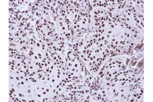 IHC-P Image Immunohistochemical analysis of paraffin-embedded Cal27 Xenograft, using Apoptosis-enhancing nuclease, antibody at 1:100 dilution.