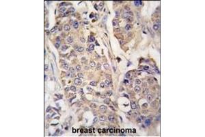 Formalin-fixed and paraffin-embedded human breast carcinoma tissue reacted with ACO2 antibody (Center) (ABIN391809 and ABIN2841660) , which was peroxidase-conjugated to the secondary antibody, followed by DAB staining. (ACO2 Antikörper  (AA 294-325))