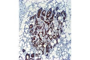 TGFB2 Antibody (ABIN659106 and ABIN2838086) immunohistochemistry analysis in formalin fixed and paraffin embedded human colon carcinoma followed by peroxidase conjμgation of the secondary antibody and DAB staining. (TGFB2 Antikörper)