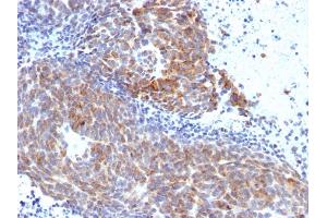 Formalin-fixed, paraffin-embedded human Melanoma stained with Topo I, MT Mouse Monoclonal Antibody (TOP1MT/568). (TOP1MT Antikörper)
