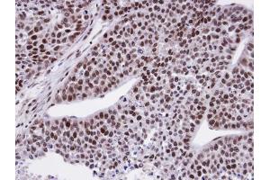 IHC-P Image Immunohistochemical analysis of paraffin-embedded HeLa xenograft, using CTDP1 , antibody at 1:100 dilution. (CTDP1 Antikörper  (N-Term))