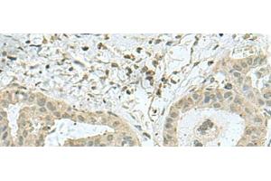 Immunohistochemistry of paraffin-embedded Human thyroid cancer tissue using THTPA Polyclonal Antibody at dilution of 1:70(x200) (THTPA Antikörper)