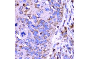 Immunohistochemistry of paraffin-embedded human esophageal cancer using SPARC antibody (ABIN5970787) at dilution of 1/100 (40x lens). (SPARC Antikörper)
