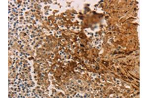 The image on the left is immunohistochemistry of paraffin-embedded Human tonsil tissue using ABIN7189672(ADCYAP1R1 Antibody) at dilution 1/70, on the right is treated with synthetic peptide. (ADCYAP1R1 Antikörper)