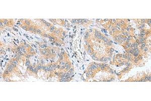 Immunohistochemistry of paraffin-embedded Human lung cancer tissue using RPS16 Polyclonal Antibody at dilution of 1:60(x200) (RPS16 Antikörper)