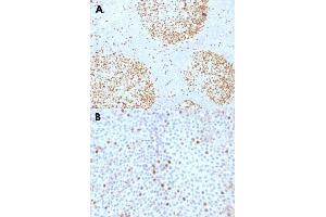 Immunohistochemical staining (Formalin-fixed paraffin-embedded sections) of human tonsil (A) and human bladder carcinoma (B) with TOP2A monoclonal antibody, clone TOP2A/1361 . (Topoisomerase II alpha Antikörper  (AA 1352-1493))