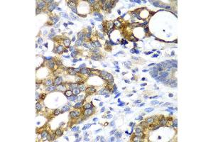 Immunohistochemistry of paraffin-embedded human gastric cancer using AMY2A antibody at dilution of 1:100 (x40 lens).