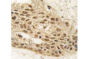 IHC analysis Dnmt3a antibody and human lung carcinoma tissue (DNMT3A Antikörper  (AA 31-61))