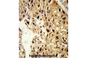 Formalin-fixed and paraffin-embedded human hepatocarcinoma reacted with PCBD1 Antibody (Center), which was peroxidase-conjugated to the secondary antibody, followed by DAB staining.