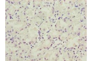 Immunohistochemistry of paraffin-embedded human gastric cancer using ABIN7158154 at dilution of 1:100 (LRRC2 Antikörper  (AA 1-184))