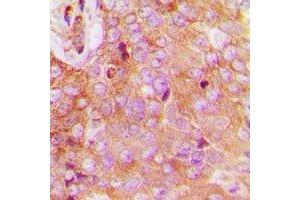 Immunohistochemical analysis of FAM84B staining in human breast cancer formalin fixed paraffin embedded tissue section. (FAM84B Antikörper  (N-Term))