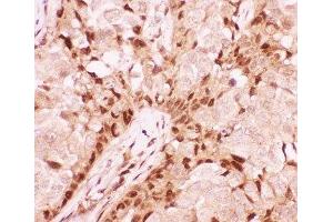 IHC-P: RUNX1 antibody testing of human breast cancer tissue (RUNX1 Antikörper  (Middle Region))