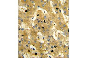 Formalin-fixed and paraffin-embedded human hepatocarcinoma reacted with SCP2 Antibody (Center), which was peroxidase-conjugated to the secondary antibody, followed by DAB staining. (SCP2 Antikörper  (AA 358-385))