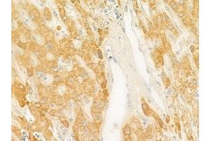 ABIN6261293 and ABIN6279350 at 1/100 staining human hepatocellular carcinoma by IHC-P.