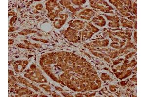 IHC image of ABIN7148861 diluted at 1:600 and staining in paraffin-embedded human pancreatic cancer performed on a Leica BondTM system. (CDK17 Antikörper  (AA 337-523))