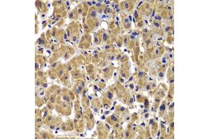 Immunohistochemistry of paraffin-embedded human liver cancer using MMP14 antibody. (MMP14 Antikörper)