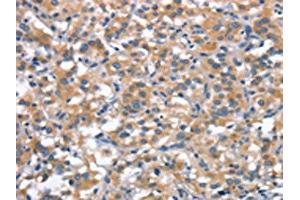The image on the left is immunohistochemistry of paraffin-embedded Human thyroid cancer tissue using ABIN7189813(ANP32C Antibody) at dilution 1/30, on the right is treated with synthetic peptide. (ANP32C Antikörper)