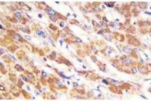 Immunohistochemistry (IHC) analyzes of Bax antibody in paraffin-embedded human liver carcinoma tissue.