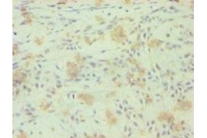 Immunohistochemistry of paraffin-embedded human breast cancer using ABIN7161881 at dilution of 1:100 (RORC Antikörper  (AA 1-518))