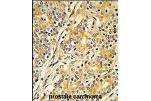 Formalin-fixed and paraffin-embedded human prostate carcinoma reacted with CYP51A1 Antibody , which was peroxidase-conjugated to the secondary antibody, followed by DAB staining. (CYP51A1 Antikörper  (C-Term))