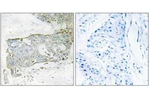 Immunohistochemistry analysis of paraffin-embedded human breast carcinoma tissue, using FA7 (light chain,Cleaved-Arg212) Antibody. (Factor VII Antikörper  (Cleaved-Arg212))