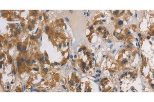Immunohistochemistry of paraffin-embedded Human thyroid cancer tissue using DUSP26 Polyclonal Antibody at dilution 1:60