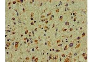 Immunohistochemistry of paraffin-embedded human glioma using ABIN7169039 at dilution of 1:100 (DCLK1 Antikörper  (AA 143-381))