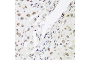 Immunohistochemistry of paraffin-embedded human lung cancer using CBX3 antibody at dilution of 1:200 (40x lens). (CBX3 Antikörper)