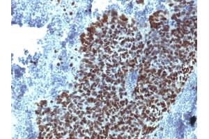 Formalin-fixed, paraffin-embedded human Prostate Carcinoma stained with FOXA1 Monoclonal Antibody (FOXA1/1514).