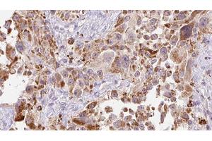 ABIN6273251 at 1/100 staining Human Melanoma tissue by IHC-P. (GREM2 Antikörper  (Internal Region))