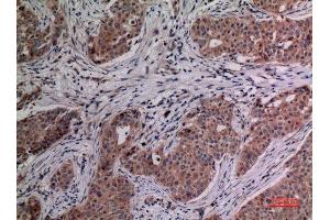 Immunohistochemistry (IHC) analysis of paraffin-embedded Human Breast Cancer, antibody was diluted at 1:100. (IL-4 Antikörper  (Internal Region))