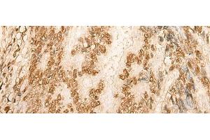 Immunohistochemistry of paraffin-embedded Human colorectal cancer tissue using HIST1H2BA Polyclonal Antibody at dilution of 1:45(x200) (HIST1H2BA Antikörper)