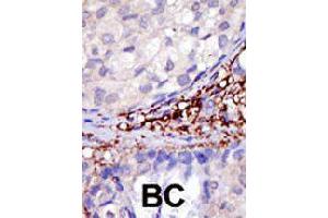 Formalin-fixed and paraffin-embedded human cancer tissue reacted with RNF216 polyclonal antibody  , which was peroxidase-conjugated to the secondary antibody, followed by DAB staining. (RNF216 Antikörper  (C-Term))