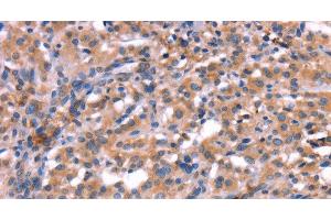 Immunohistochemistry of paraffin-embedded Human thyroid cancer using HMGCS1 Polyclonal Antibody at dilution of 1:40 (HMGCS1 Antikörper)