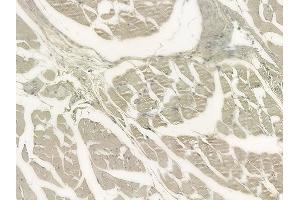 ABIN6264555 and ABIN6273303 at 1/100 staining human lung adenocarcinoma by IHC-P. (RAB12 Antikörper  (C-Term))