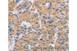 Immunohistochemistry of Human liver cancer using DKK2 Polyclonal Antibody at dilution of 1:60