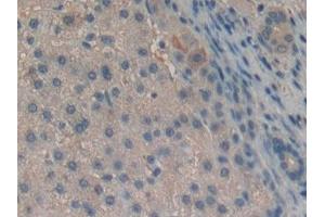 Detection of Slit2 in Human Liver cancer Tissue using Polyclonal Antibody to Slit Homolog 2 (Slit2) (SLIT2 Antikörper  (AA 1416-1528))
