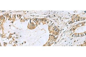 Immunohistochemistry of paraffin-embedded Human gastric cancer tissue using TUBD1 Polyclonal Antibody at dilution of 1:70(x200) (TUBD1 Antikörper)