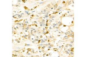 Immunohistochemistry of paraffin embedded human Cholangiocarcinoma using ANXA3 (ABIN7073065) at dilution of 1: 200 (400x lens) (Annexin A3 Antikörper)