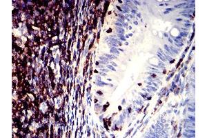 Immunohistochemical analysis of paraffin-embedded rectum cancer tissues using CD11a mouse mAb with DAB staining. (ITGAL Antikörper  (AA 26-194))