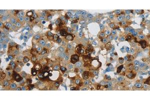 Immunohistochemistry of paraffin-embedded Human breast cancer using LCN2 Polyclonal Antibody at dilution of 1:60 (Lipocalin 2 Antikörper)