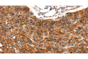 Immunohistochemistry of paraffin-embedded Human esophagus cancer tissue using TRIM69 Polyclonal Antibody at dilution 1:40 (TRIM69 Antikörper)