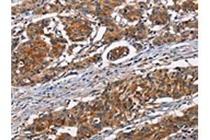 The image on the left is immunohistochemistry of paraffin-embedded Human gastic cancer tissue using ABIN7189936(ATP7A Antibody) at dilution 1/50, on the right is treated with synthetic peptide. (ATP7A Antikörper)